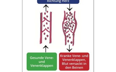 Gesunde Vene vs. kranke Vene – chronische Wundursachen